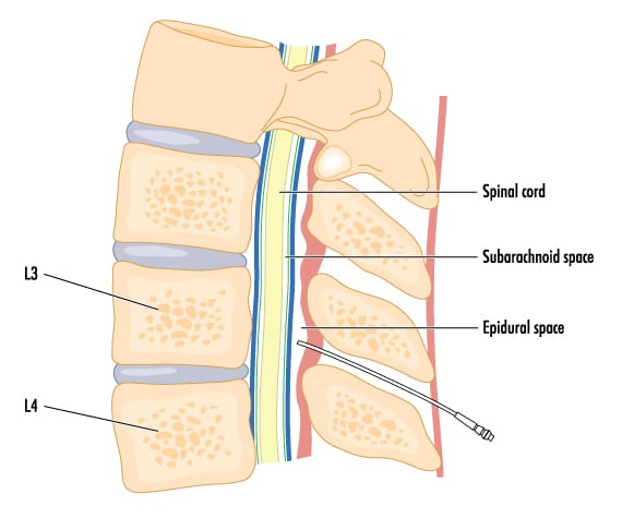 Diagram showing epidural space of spinal column