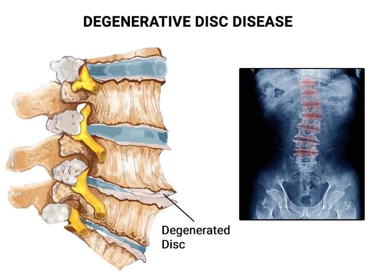 Informational graphic about degenerative disc disease