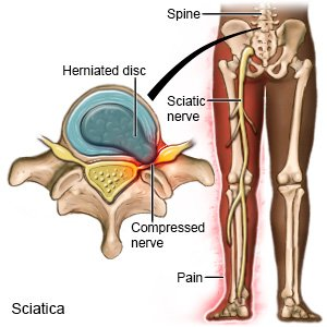 Informational graphic showing a herniated disc in sciatica