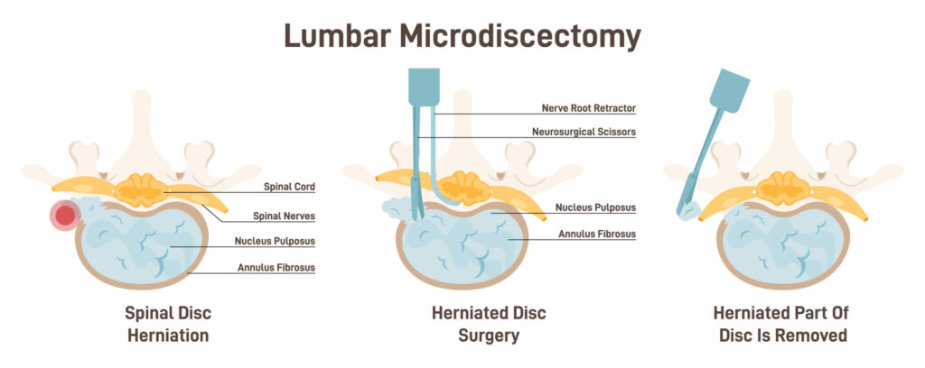 informational graphic detailing microdiscectomy