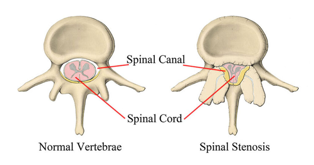 Normal vertebrae vs spinal stenosis