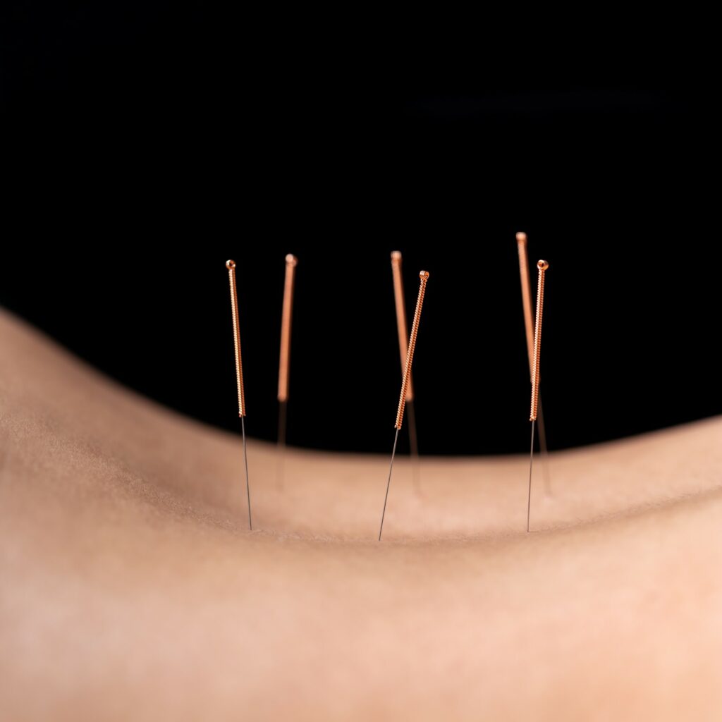 acupuncture needles in lower back