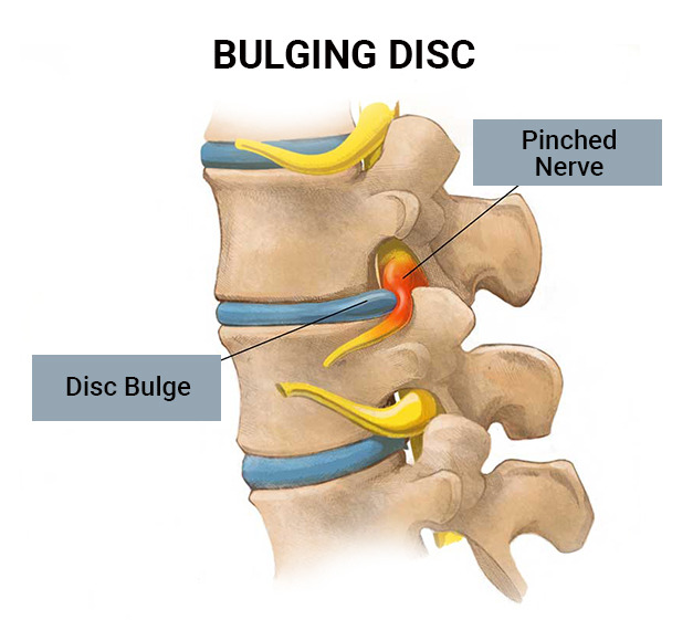 illustrated graphic depicting a bulging disc