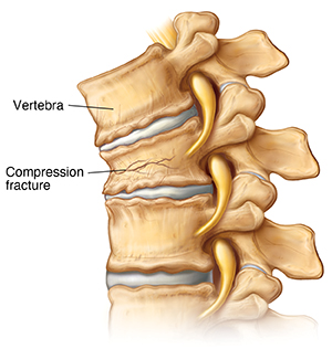 illustrated graphic depicting a compression fracture in the spine
