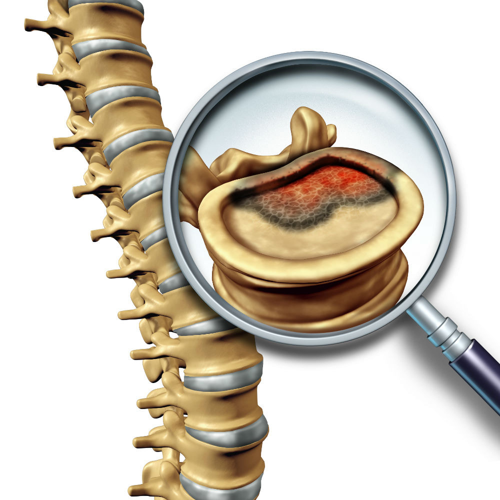 illustrated graphic depicting a spinal tumour