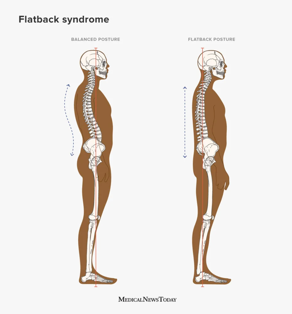informational graphic about flatback syndrome