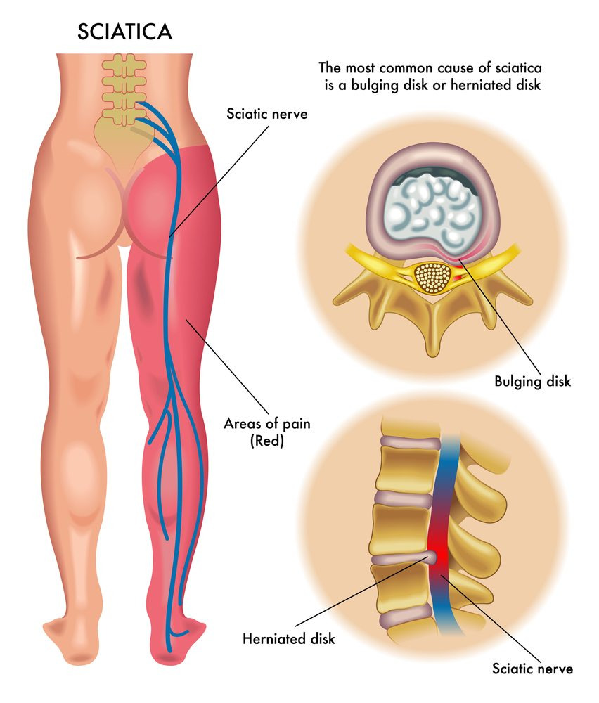 informational graphic showing what sciatic is and what causes the condition