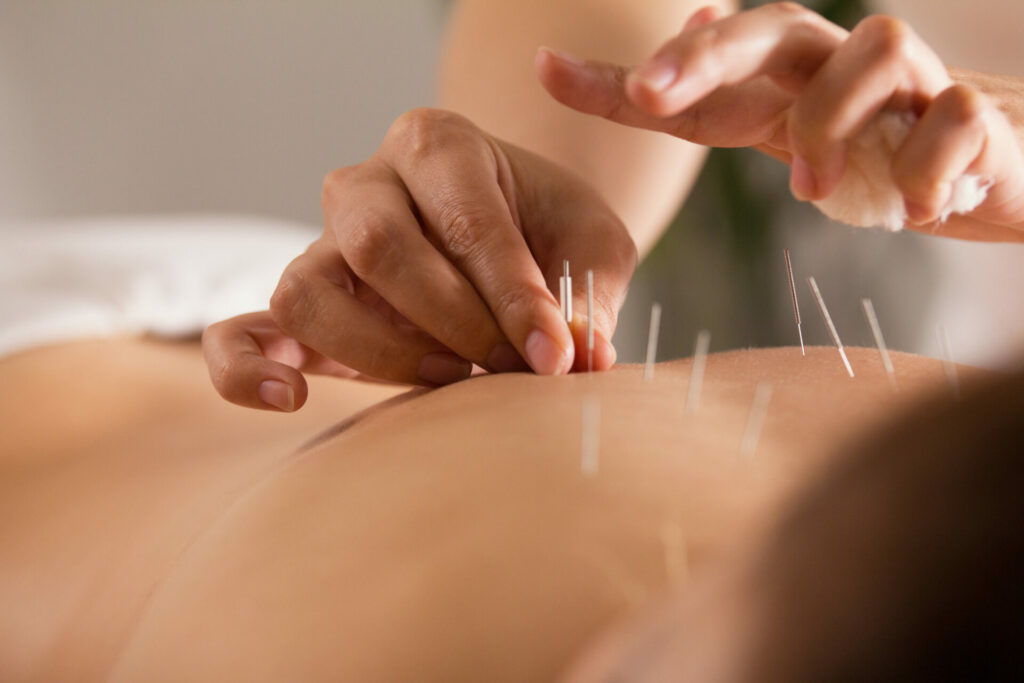person receiving acupuncture in their back