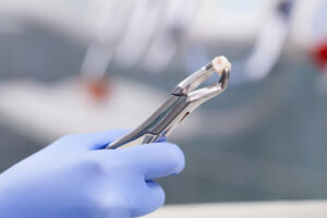 Does tooth extraction hurt?