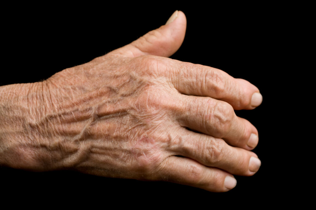old hand with arthritis