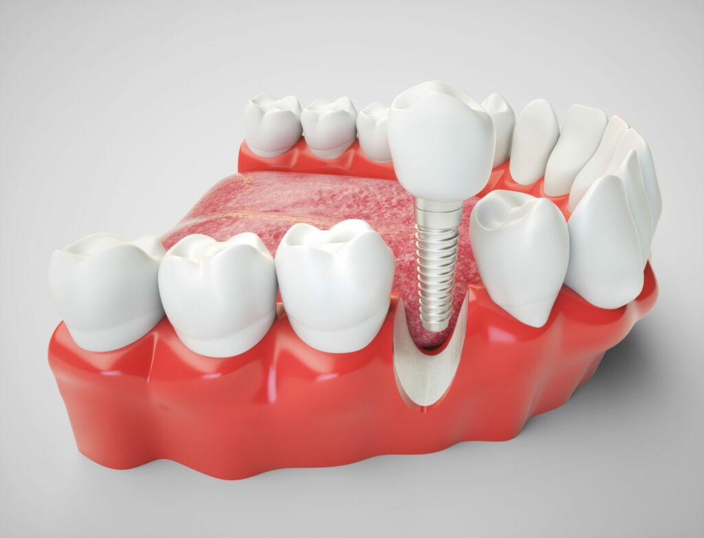 3D rendering of a dental implant